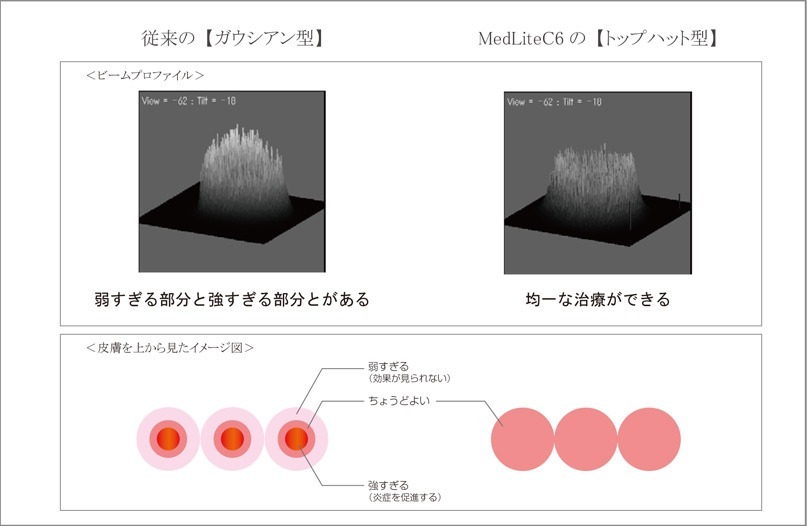 肝斑治療を可能にする理由2　弱いパワーでの照射