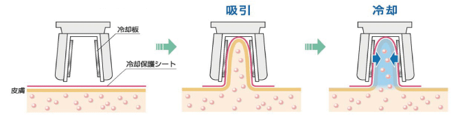 冷却痩身(クライオリポライシス)